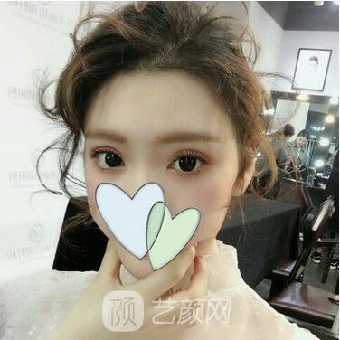 重慶鵬愛(ài)李晨耕自體脂肪面部填充一個(gè)月案例分享~